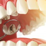 金属アレルギーでも虫歯治療は受けられる！おすすめの治療方法を紹介