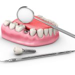 インプラント手術後の過ごし方｜注意点と対処法