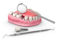 インプラント手術後の過ごし方｜注意点と対処法